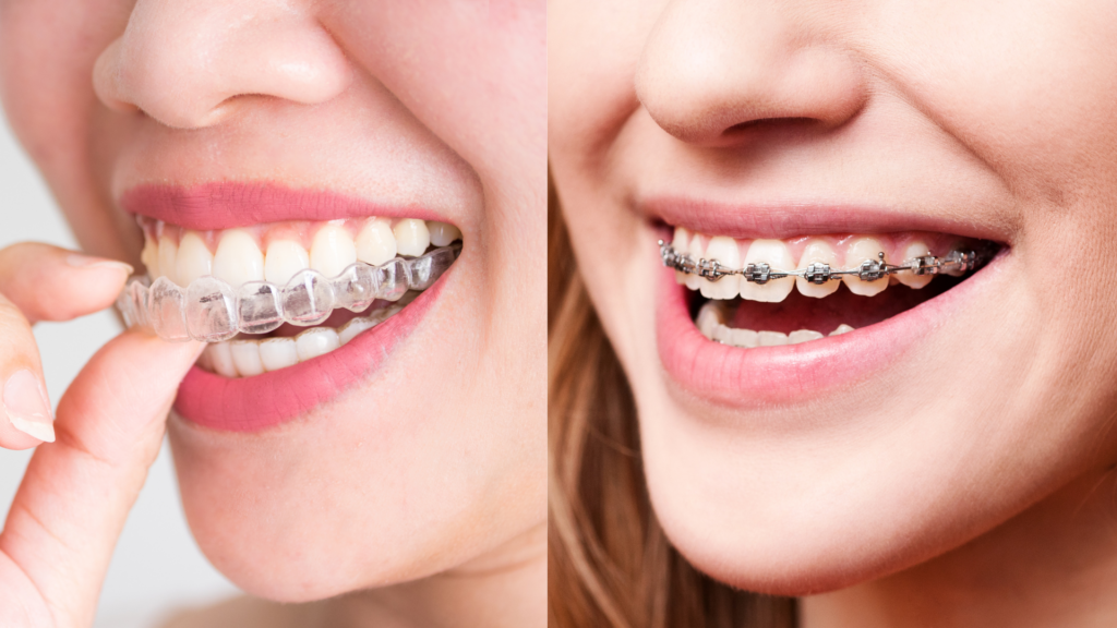 SureSmile vs. Braces: Pros and Cons