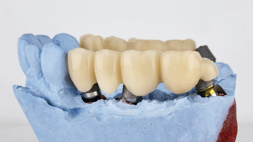 Dental Bridges in Marietta, GA: What to Know Before You Choose