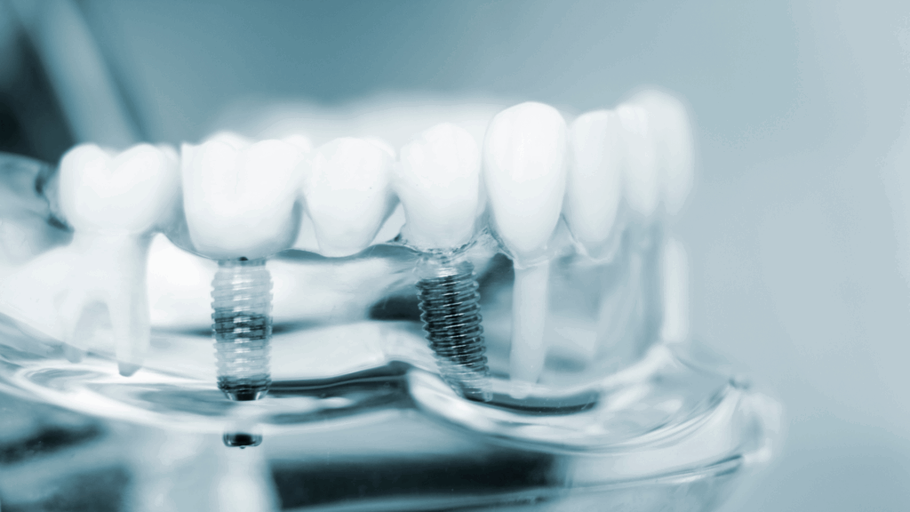 Dental Implants in Marietta, GA: A Lasting Solution for Missing Teeth