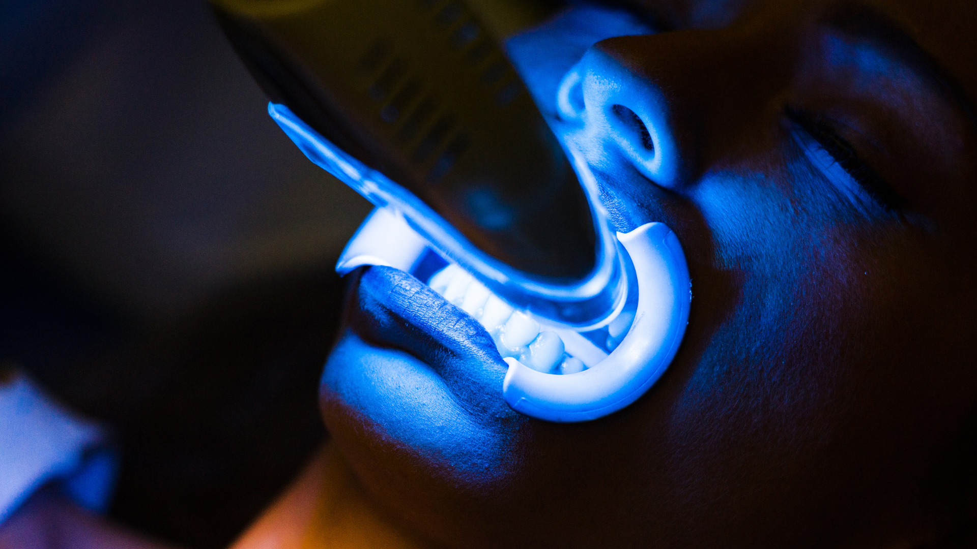 Does Teeth Whitening Hurt?